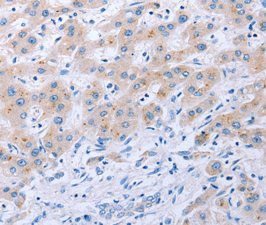 Immunohistochemistry of paraffin-embedded Human liver cancer tissue using FGF4 Polyclonal Antibody at dilution 1:40