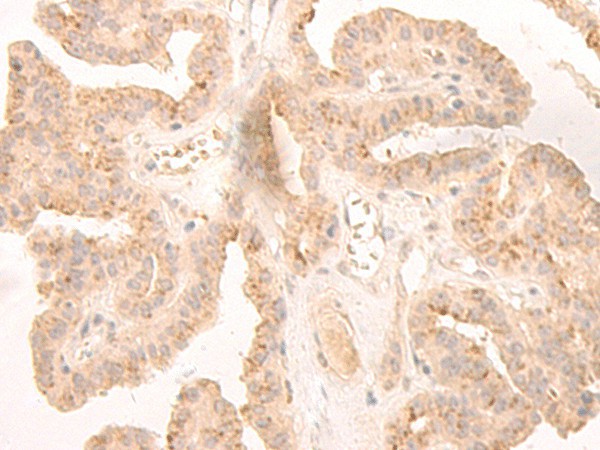 Immunohistochemistry of paraffin-embedded Human thyroid cancer tissue  using LCMT2 Polyclonal Antibody at dilution of 1:45(?200)