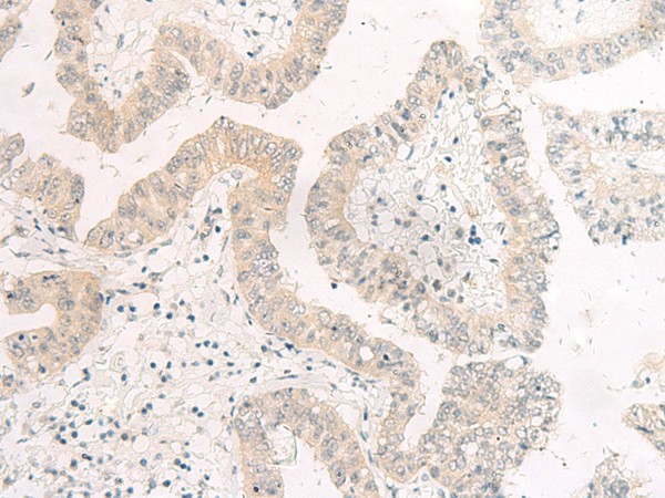 Immunohistochemistry of paraffin-embedded Human liver cancer tissue  using HASPIN Polyclonal Antibody at dilution of 1:45(?200)