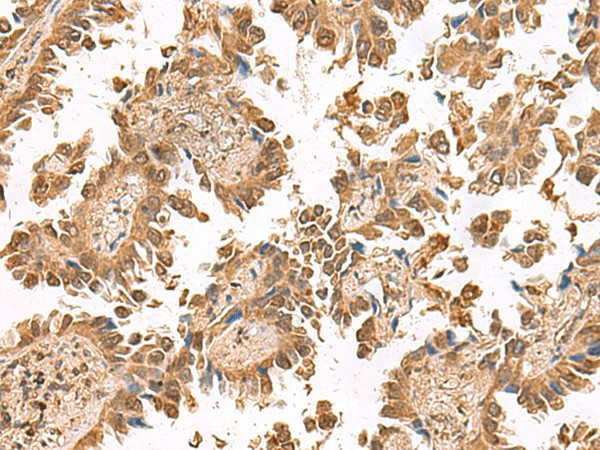 Immunohistochemistry of paraffin-embedded Human lung cancer tissue  using PTH1R Polyclonal Antibody at dilution of 1:55(?200)