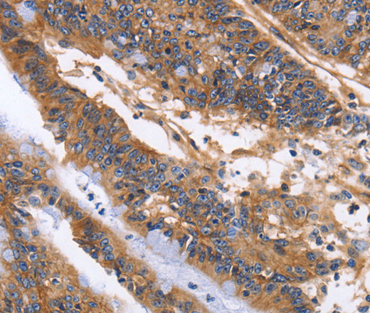 Immunohistochemistry of paraffin-embedded Human colon cancer using ITGB1 Polyclonal Antibody at dilution of 1:60