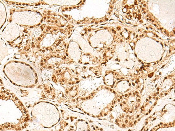 Immunohistochemistry of paraffin-embedded Human thyroid cancer tissue  using PAF1 Polyclonal Antibody at dilution of 1:55(?200)