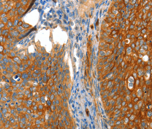 Immunohistochemistry of paraffin-embedded Human cervical cancer tissue using VWA5A Polyclonal Antibody at dilution 1:80