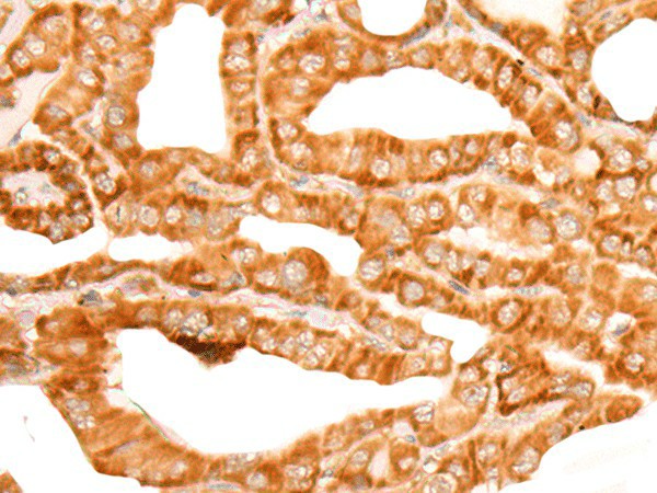 Immunohistochemistry of paraffin-embedded Human thyroid cancer tissue  using ZMYND10 Polyclonal Antibody at dilution of 1:35(?200)