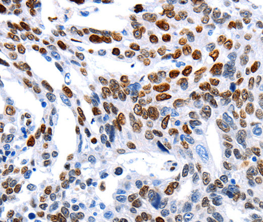 Immunohistochemistry of paraffin-embedded Human ovarian cancer using MUTYH Polyclonal Antibody at dilution of 1:60