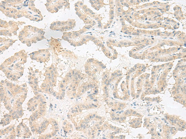 Immunohistochemistry of paraffin-embedded Human thyroid cancer tissue  using EPRS Polyclonal Antibody at dilution of 1:60(?200)