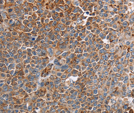 Immunohistochemistry of paraffin-embedded Human ovarian cancer tissue using PLXNA2 Polyclonal Antibody at dilution 1:40