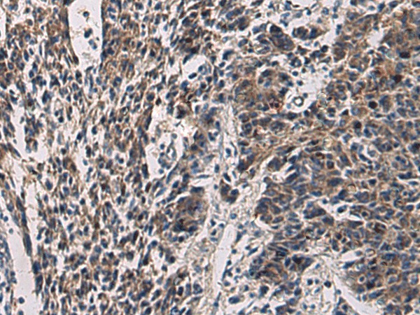 Immunohistochemistry of paraffin-embedded Human colorectal cancer tissue  using CCNI Polyclonal Antibody at dilution of 1:60(?200)