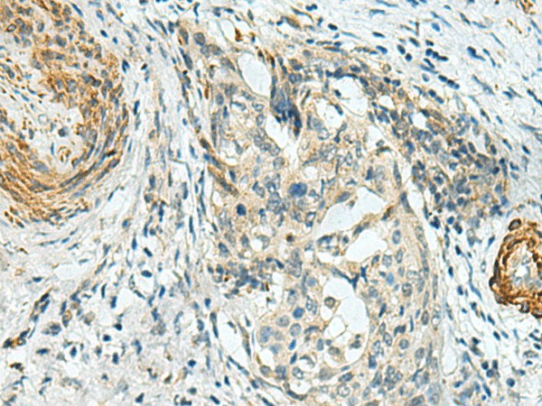 Immunohistochemistry of paraffin-embedded Human cervical cancer tissue  using PLPPR5 Polyclonal Antibody at dilution of 1:120(?200)