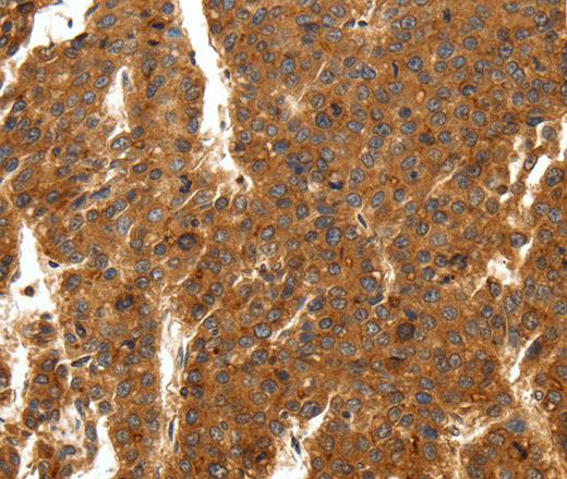 Immunohistochemistry of paraffin-embedded Human breast cancer tissue using SCN11A Polyclonal Antibody at dilution 1:50