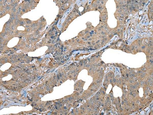 Immunohistochemistry of paraffin-embedded Human colorectal cancer tissue  using DDC Polyclonal Antibody at dilution of 1:30(?200)