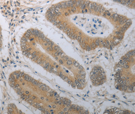 Immunohistochemistry of paraffin-embedded Human colon cancer tissue using SHH Polyclonal Antibody at dilution 1:70