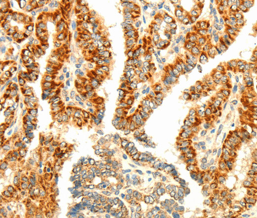 Immunohistochemistry of paraffin-embedded Human thyroid cancer using AARS2 Polyclonal Antibody at dilution of 1:80