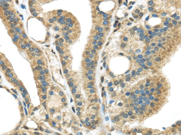 Immunohistochemistry of paraffin-embedded Human thyroid cancer tissue using STK35 Polyclonal Antibody at dilution 1:45