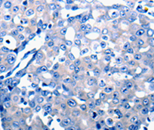 Immunohistochemistry of paraffin-embedded Human breast cancer tissue using CCL2 Polyclonal Antibody at dilution 1:50