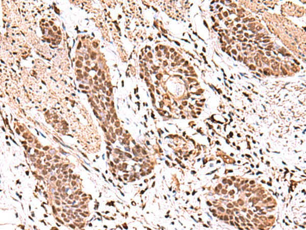 Immunohistochemistry of paraffin-embedded Human esophagus cancer tissue  using ACTL6B Polyclonal Antibody at dilution of 1:100(?200)