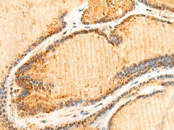 Immunohistochemistry of paraffin-embedded Human thyroid cancer tissue  using ZNF581 Polyclonal Antibody at dilution of 1:50(?200)