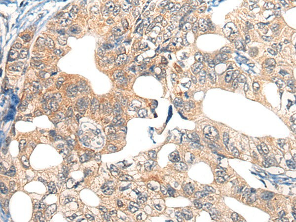 Immunohistochemistry of paraffin-embedded Human gastric cancer tissue  using EPHA6 Polyclonal Antibody at dilution of 1:40(?200)