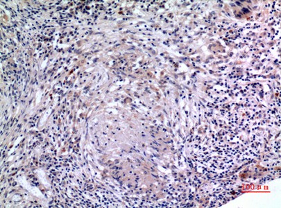 Immunohistochemistry of paraffin-embedded Human lung tissue using IL6 Polyclonal Antibody at dilution of 1:100.