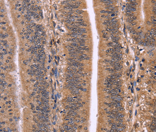 Immunohistochemistry of paraffin-embedded Human colon cancer using CLUAP1 Polyclonal Antibody at dilution of 1:50