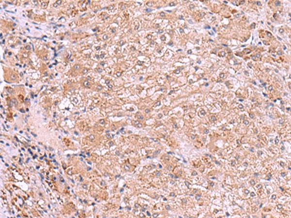 Immunohistochemistry of paraffin-embedded Human liver cancer tissue  using RIC3 Polyclonal Antibody at dilution of 1:90(?200)