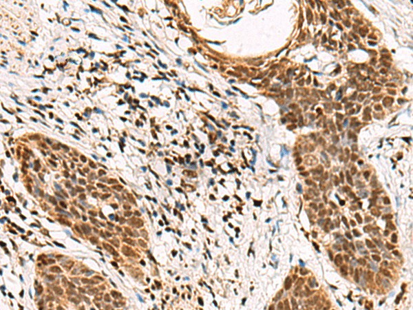 Immunohistochemistry of paraffin-embedded Human esophagus cancer tissue  using GABPB1 Polyclonal Antibody at dilution of 1:70(?200)