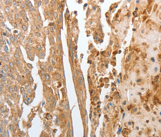 Immunohistochemistry of paraffin-embedded Human cervical cancer using NPY1R Polyclonal Antibody at dilution of 1:30