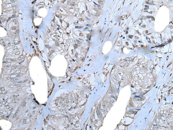 Immunohistochemistry of paraffin-embedded Human colorectal cancer tissue  using ZNF703 Polyclonal Antibody at dilution of 1:40(?200)