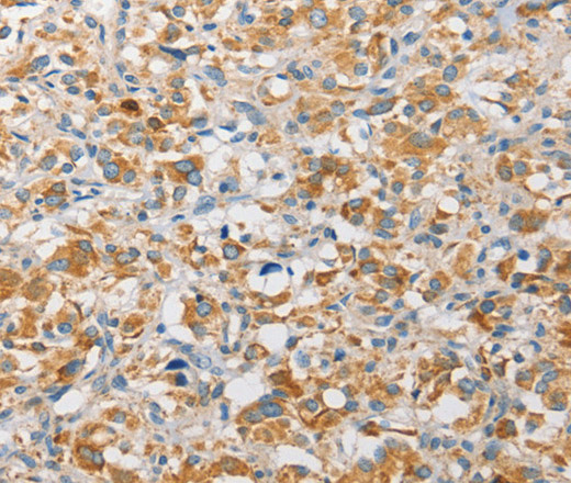 Immunohistochemistry of paraffin-embedded Human thyroid cancer using APOBEC3G Polyclonal Antibody at dilution of 1:30