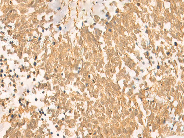 Immunohistochemistry of paraffin-embedded Human lung cancer tissue  using UBD Polyclonal Antibody at dilution of 1:50(?200)