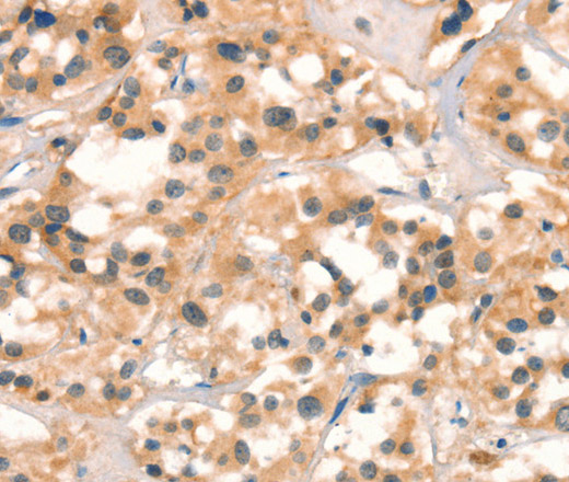 Immunohistochemistry of paraffin-embedded Human thyroid cancer tissue using CUEDC2 Polyclonal Antibody at dilution 1:30