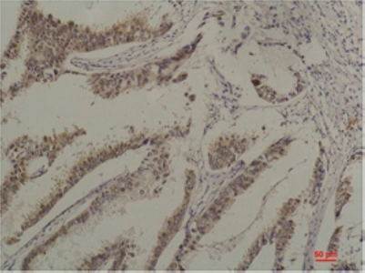 Immunohistochemistry of paraffin-embedded Human breast carcinoma tissue using HSPA8 Monoclonal Antibody at dilution of 1:200.