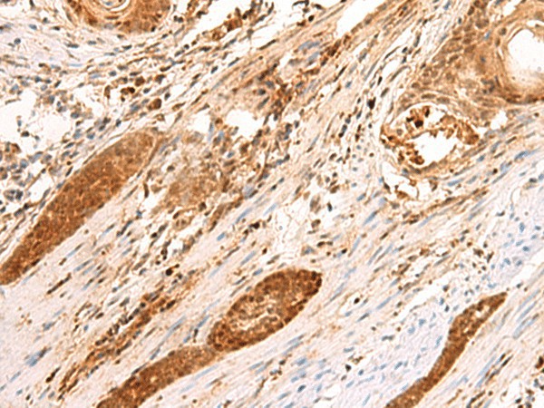 Immunohistochemistry of paraffin-embedded Human esophagus cancer tissue  using SCAND1 Polyclonal Antibody at dilution of 1:90(?200)