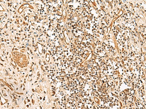 Immunohistochemistry of paraffin-embedded Human prost ate cancer tissue  using HUS1 Polyclonal Antibody at dilution of 1:65(?200)