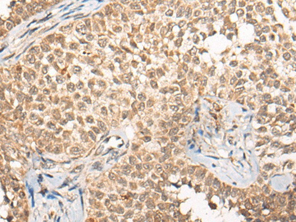 Immunohistochemistry of paraffin-embedded Human ovarian cancer tissue  using CABIN1 Polyclonal Antibody at dilution of 1:50(?200)