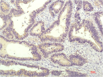 Immunohistochemistry of paraffin-embedded Human colon carcinoma tissue using STAT1 Monoclonal Antibody at dilution of 1:200.