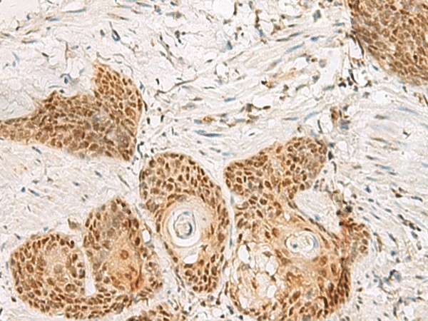 Immunohistochemistry of paraffin-embedded Human esophagus cancer tissue  using PSPC1 Polyclonal Antibody at dilution of 1:30(?200)