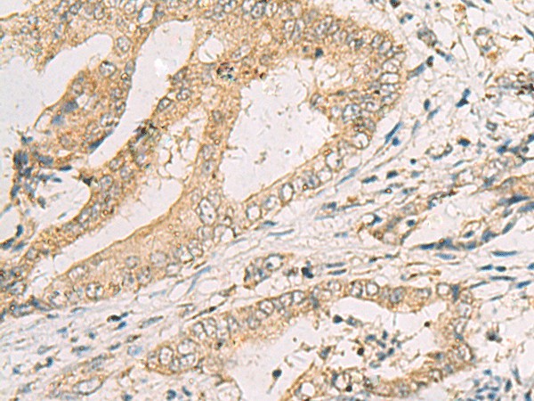 Immunohistochemistry of paraffin-embedded Human cervical cancer tissue  using SPACA1 Polyclonal Antibody at dilution of 1:50(?200)