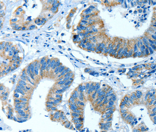 Immunohistochemistry of paraffin-embedded Human colon cancer using ALDH4A1 Polyclonal Antibody at dilution of 1:35