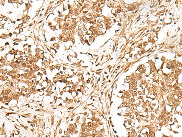 Immunohistochemistry of paraffin-embedded Human lung cancer tissue  using GMEB2 Polyclonal Antibody at dilution of 1:30(?200)