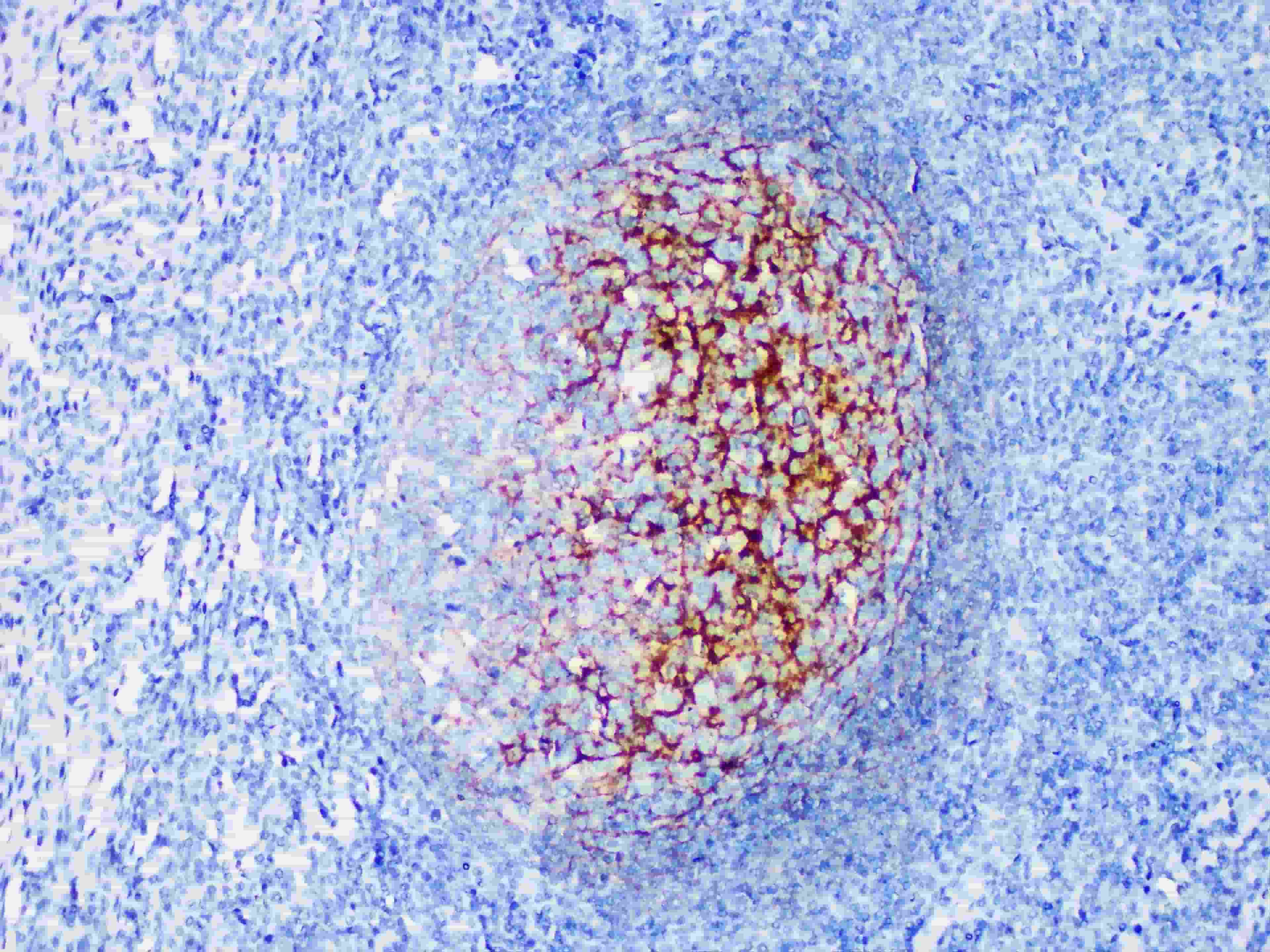 Immunohistochemistry of paraffinembedded Human tonsil tissue with CD35 Monoclonal Antibody(Antigen repaired by EDTA).