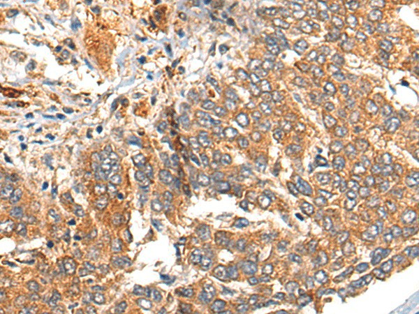 Immunohistochemistry of paraffin-embedded Human liver cancer tissue  using MARK2 Polyclonal Antibody at dilution of 1:35(?200)