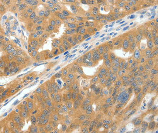 Immunohistochemistry of paraffin-embedded Human ovarian cancer tissue using SCN9A Polyclonal Antibody at dilution 1:40