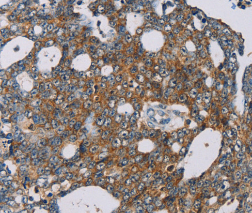 Immunohistochemistry of paraffin-embedded Human cervical cancer using MRPL39 Polyclonal Antibody at dilution of 1:30