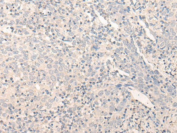 Immunohistochemistry of paraffin-embedded Human cervical cancer tissue  using RADIL Polyclonal Antibody at dilution of 1:40(?200)