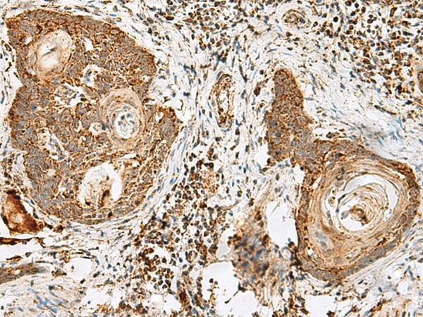 Immunohistochemistry of paraffin-embedded Human esophagus cancer tissue  using CD48 Polyclonal Antibody at dilution of 1:40(?200)