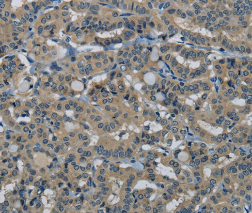 Immunohistochemistry of paraffin-embedded Human thyroid cancer tissue using HSPG2 Polyclonal Antibody at dilution 1:50