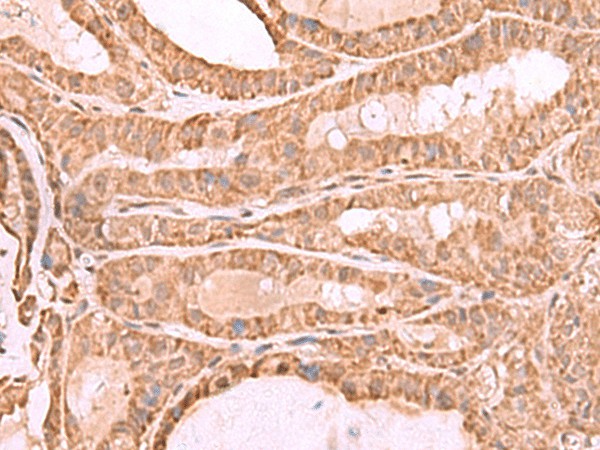 Immunohistochemistry of paraffin-embedded Human thyroid cancer tissue  using CDC20 Polyclonal Antibody at dilution of 1:70(?200)