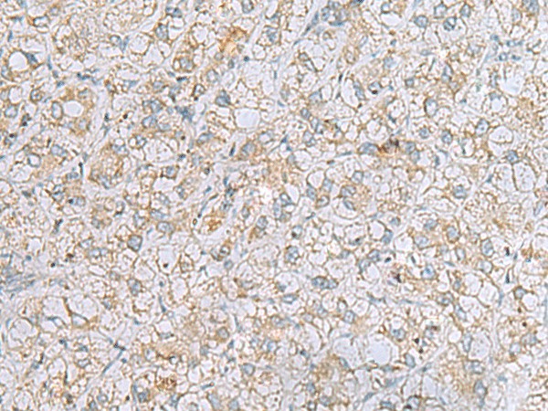 Immunohistochemistry of paraffin-embedded Human liver cancer tissue  using LRRC49 Polyclonal Antibody at dilution of 1:40(?200)