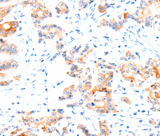 Immunohistochemistry of paraffin-embedded Human colon cancer tissue using CCDC88A Polyclonal Antibody at dilution 1:50